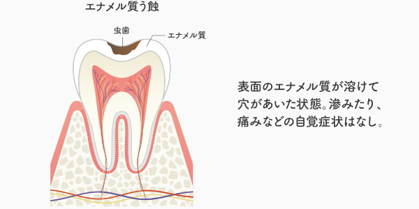 C1の虫歯の説明・イメージ画像