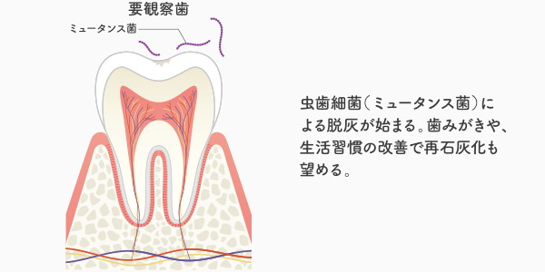 初期虫歯C0の説明・イメージ画像