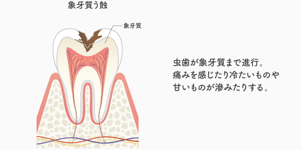 C2の虫歯の説明・イメージ画像