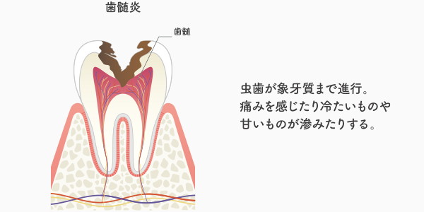 C3の虫歯の説明・イメージ画像