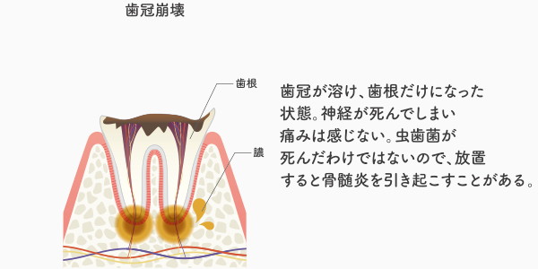 C4の虫歯の説明・イメージ画像