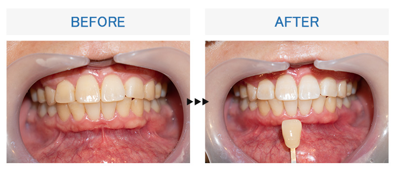 関内馬車道みなとまち歯科のホワイトニングビフォーアフター