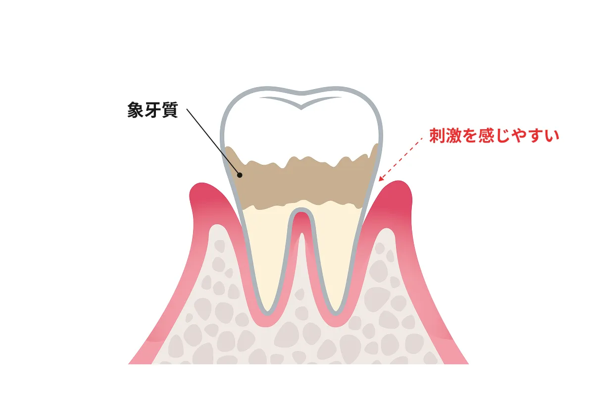 知覚過敏による歯がしみるイメージ画像