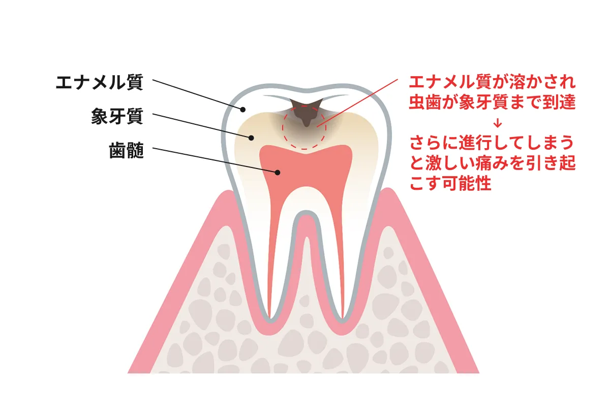 虫歯による歯がしみるイメージ画像