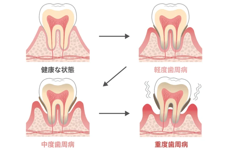 歯周病による歯がしみるイメージ画像