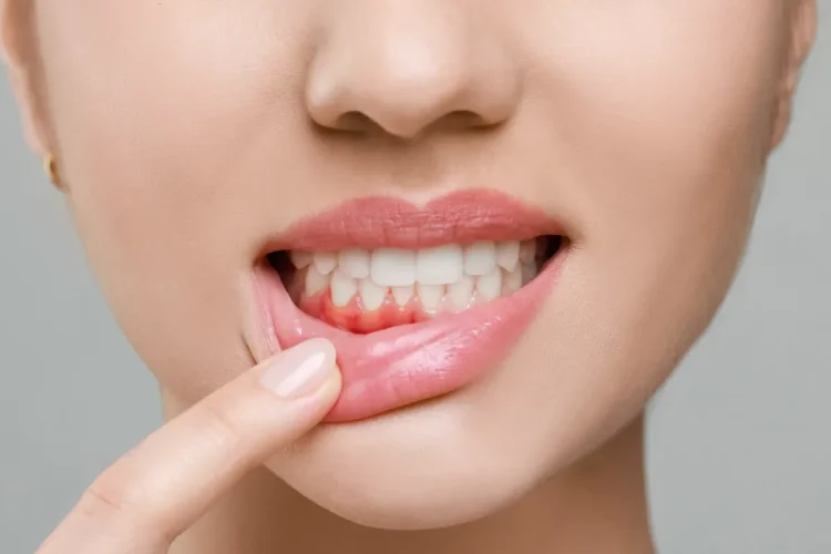 歯茎が赤く腫れ、出血している女性