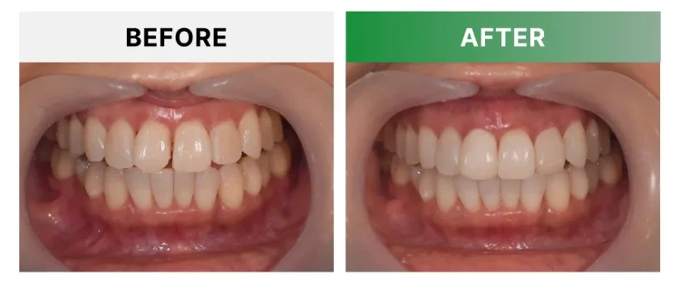 トランセントホワイトニングとラミネートベニア